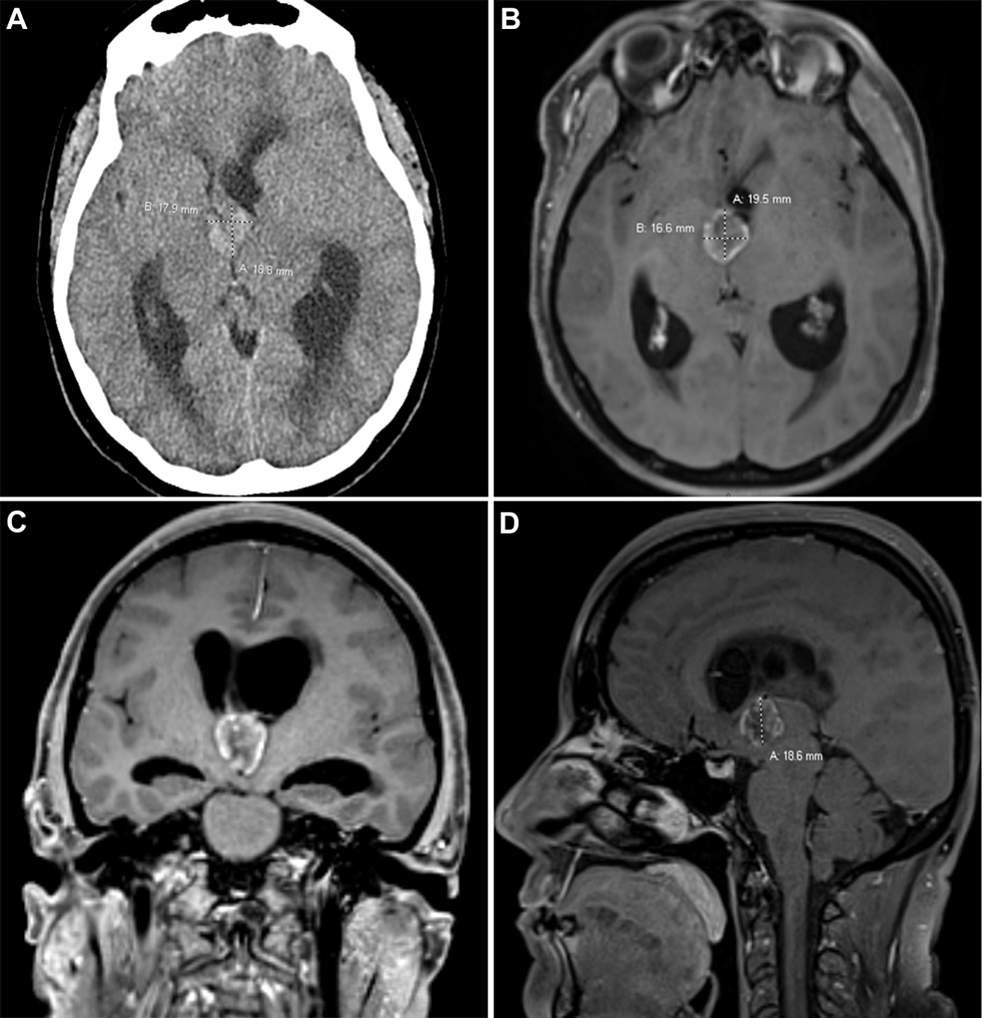 Cureus | Solitary Metastasis of Colon Adenocarcinoma Mimicking Colloid ...