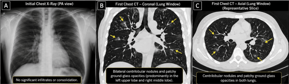 iv glutathione following ct scan Paradoxical Acute Hypoxemic Deterioration During Treatment of Bilateral Bronchopneumonia: A Case Report Reduce Glutathione Select Size:60 Scoops not feeling well