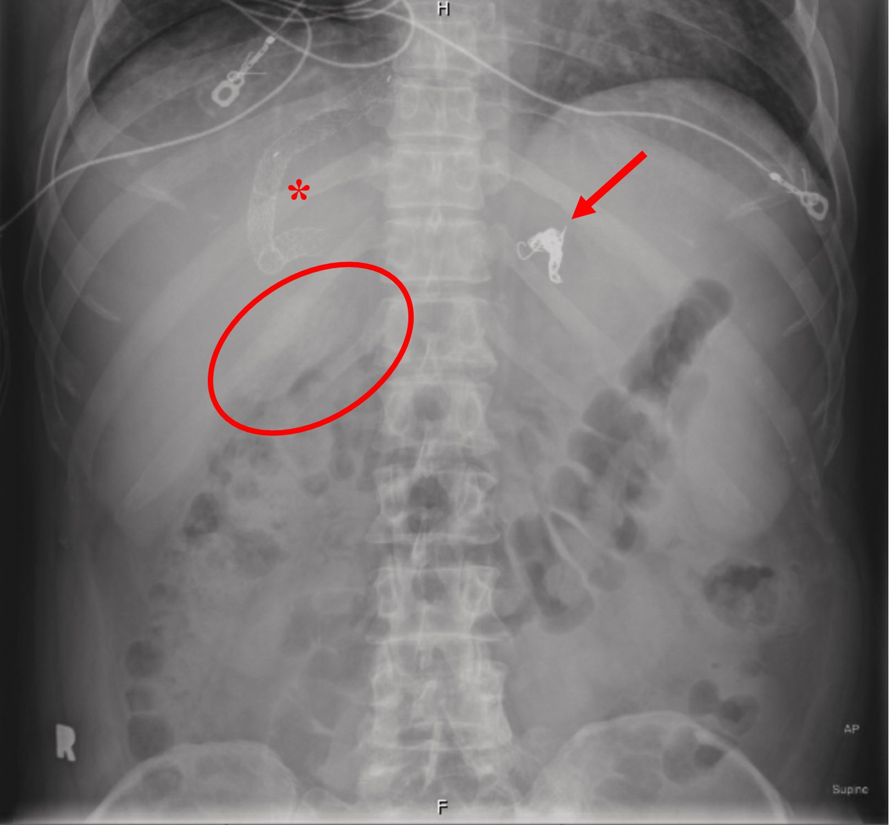 Cureus Ct Imaging Findings Of Porcelain Gallbladder And Epiploic