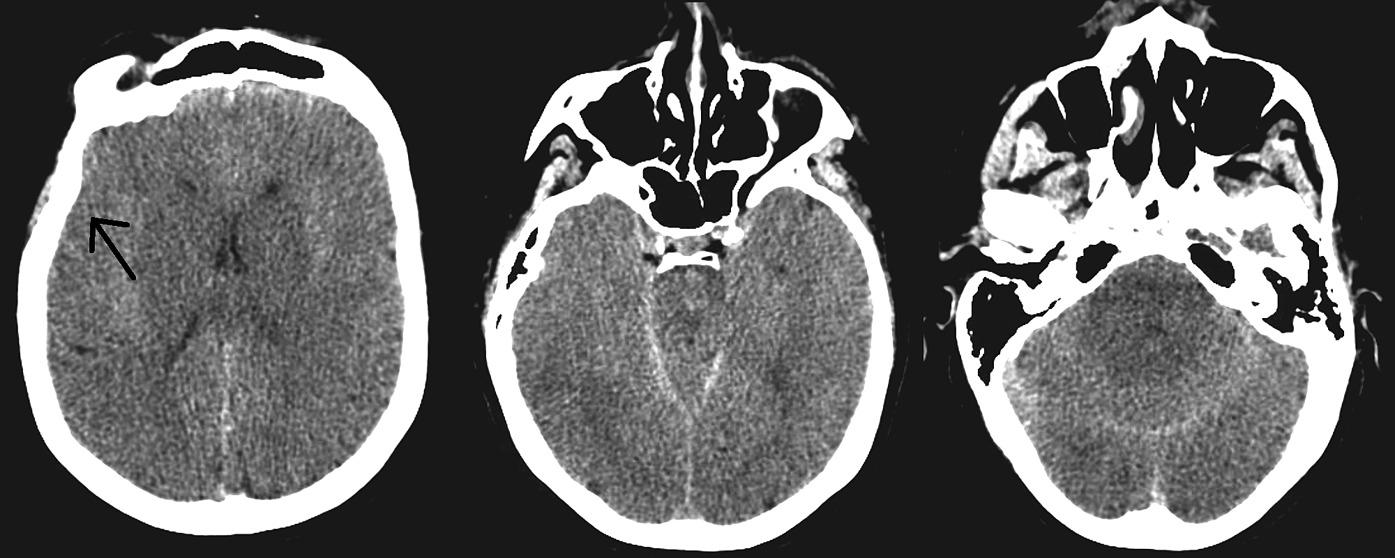 Cureus Pseudohypoxic Brain Swelling After Elective Lumbar Spinal Surgery Case Report