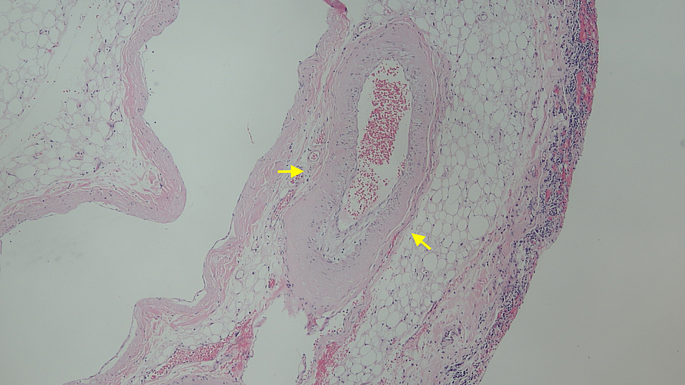 Perivascular-homogeneous-deposits-within-the-walls-showing-amyloidosis