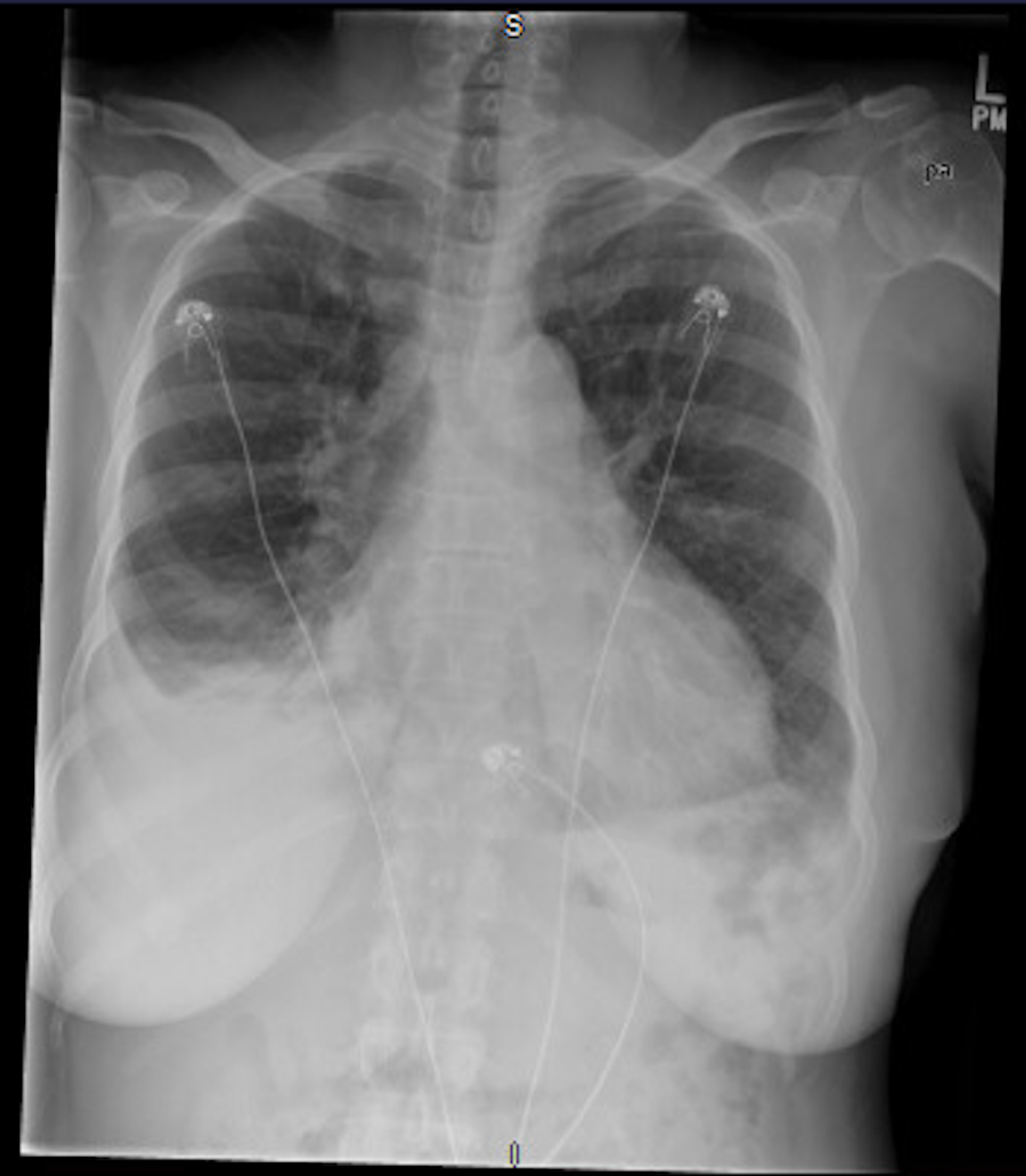 Cardiac Tamponade Chest X Ray