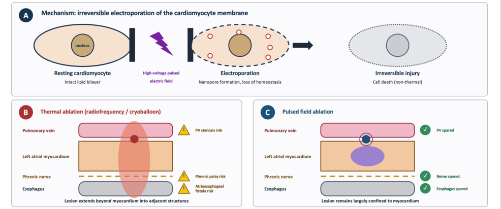 Pulsed Field Ablation for Atrial Fibrillation: Mechanism, Clinical Evidence, and Emerging Applications