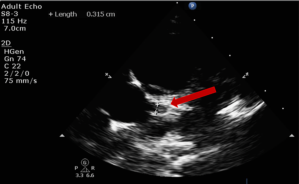 trivial pericardial effusion