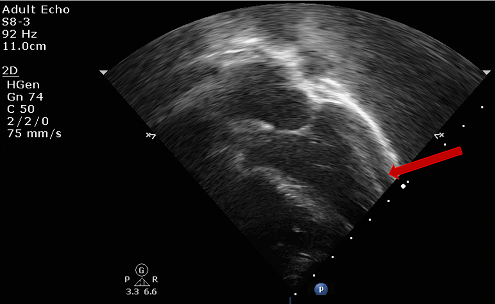 trivial pericardial effusion trivial pericardial effusion