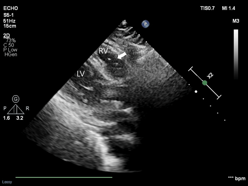 Transthoracic-echocardiography-demonstrating-echogenic-air-bubbles-within-the-right-ventricle-(white-arrow)-accompanied-by-transient-right-ventricular-dysfunction.