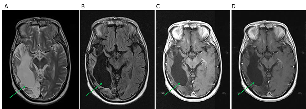Pre--and-Post-Contrast-Brain-MRI-