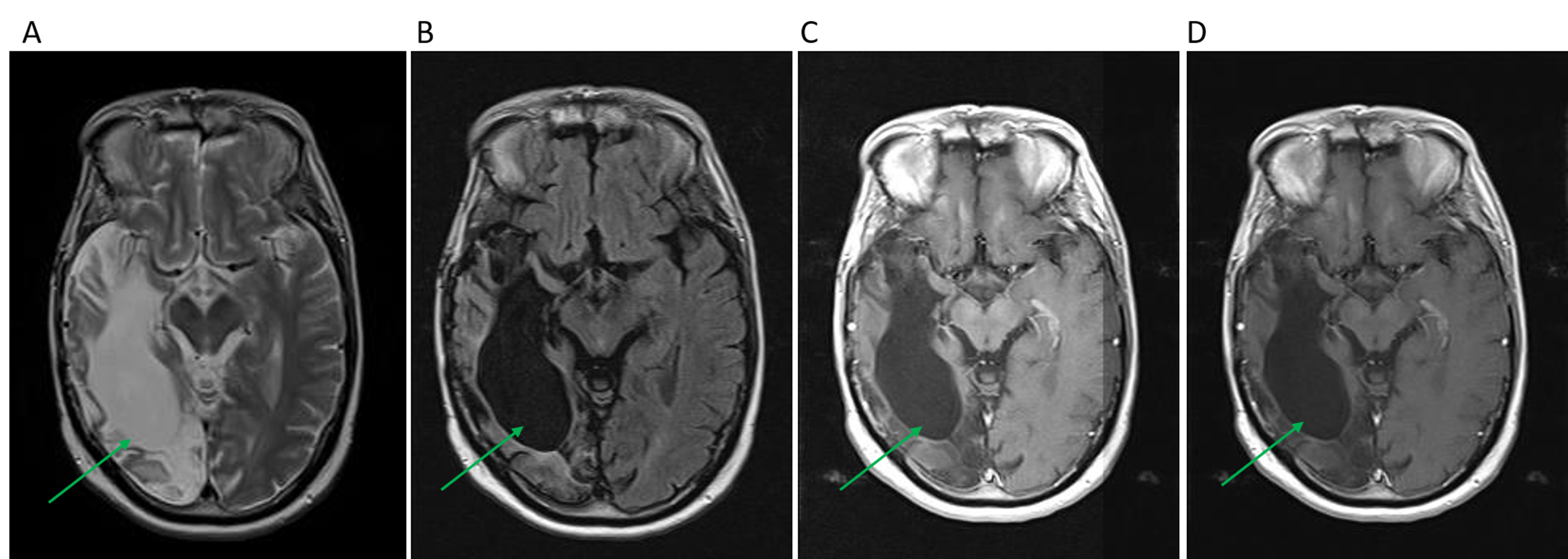 butterfly-glioblastoma-life-expectancy-porfirio-conn