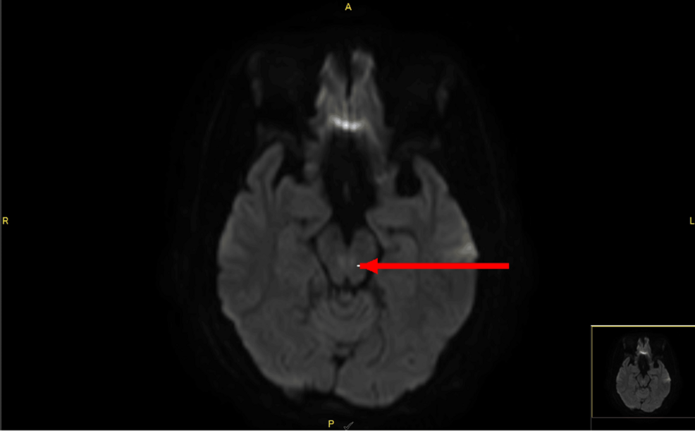 Recurrent Left Abducens Nerve Palsy and Idiopathic Intracranial Hypertension During Pregnancy: A Diagnostic Challenge
