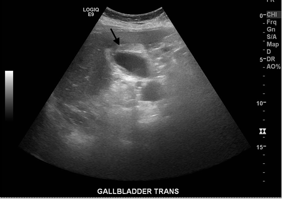 Cureus Acute Acalculous Cholecystitis Due to COVID19, an Unusual