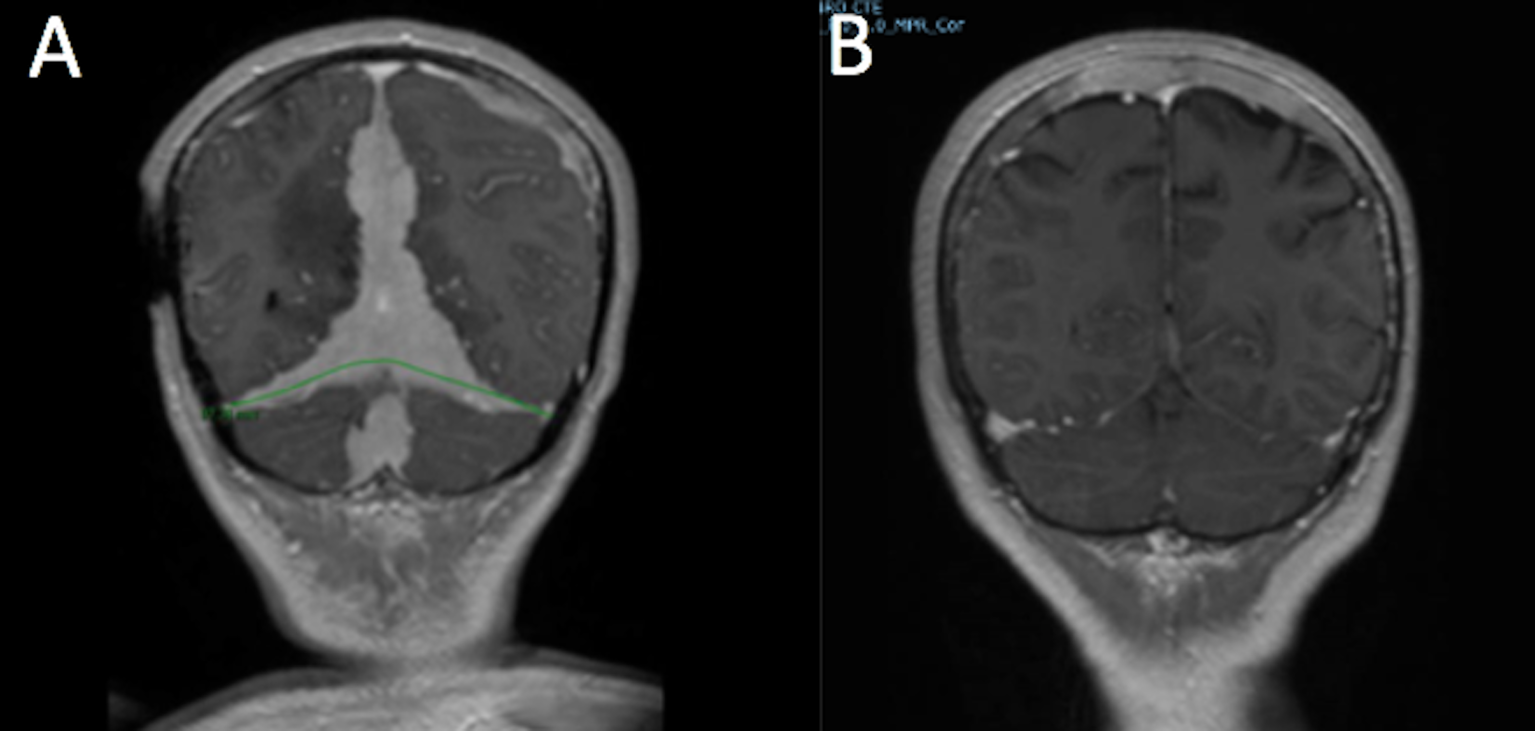 Cureus Local Control Of Primary Dural Central Nervous System Lymphoma Achieved With Radiotherapy