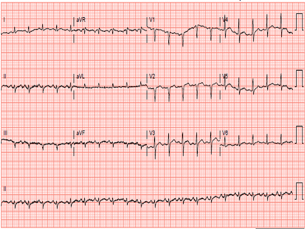 Cureus | “My Heart Said It’s Swollen”: A Rare Case of Clozapine-Induced ...