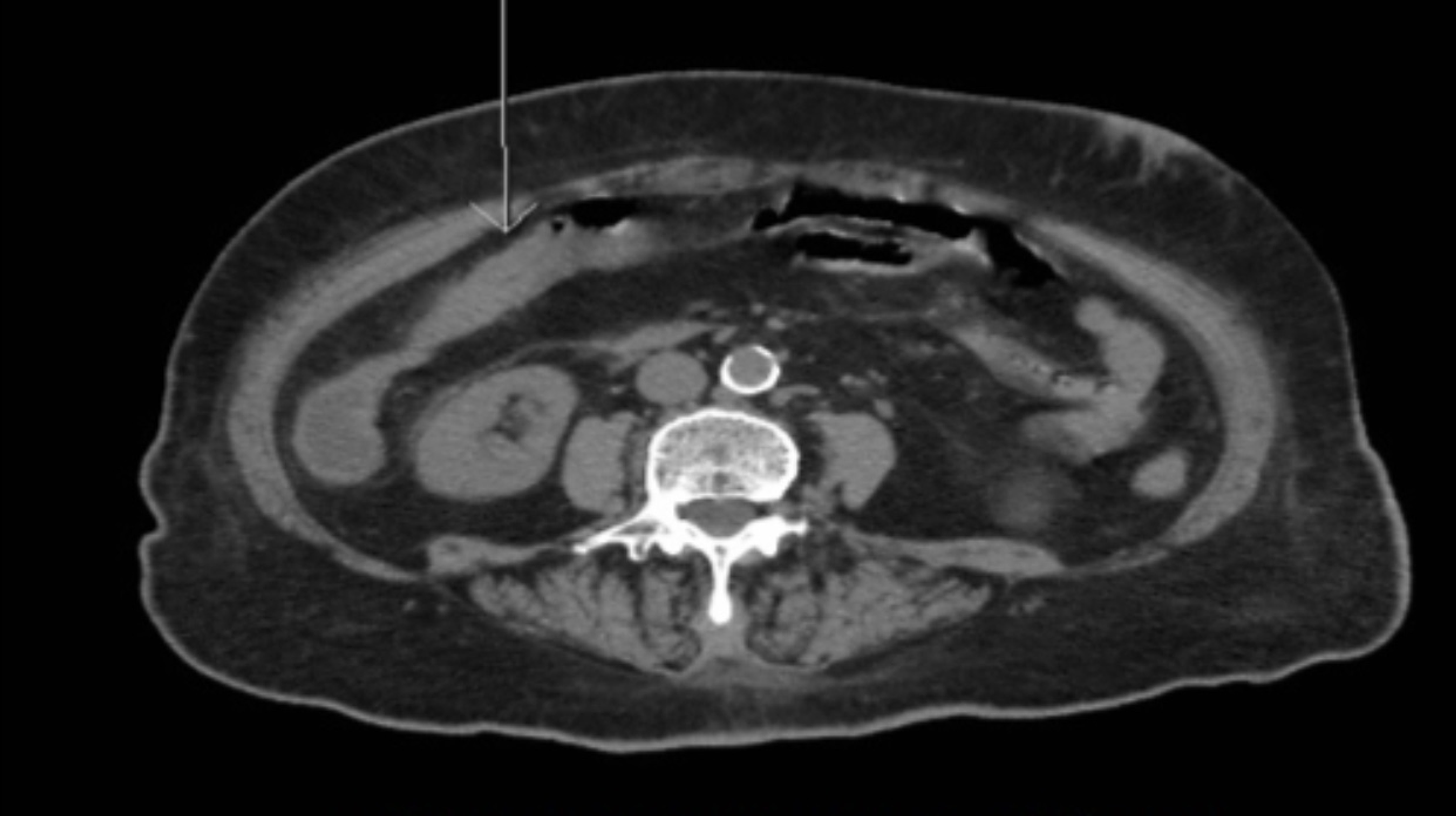 Cureus Colonic Stricture Secondary to Recurrent Ischemic Colitis