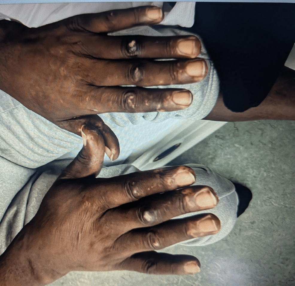 Man with Rare Anti-Fibrillarin Systemic Sclerosis