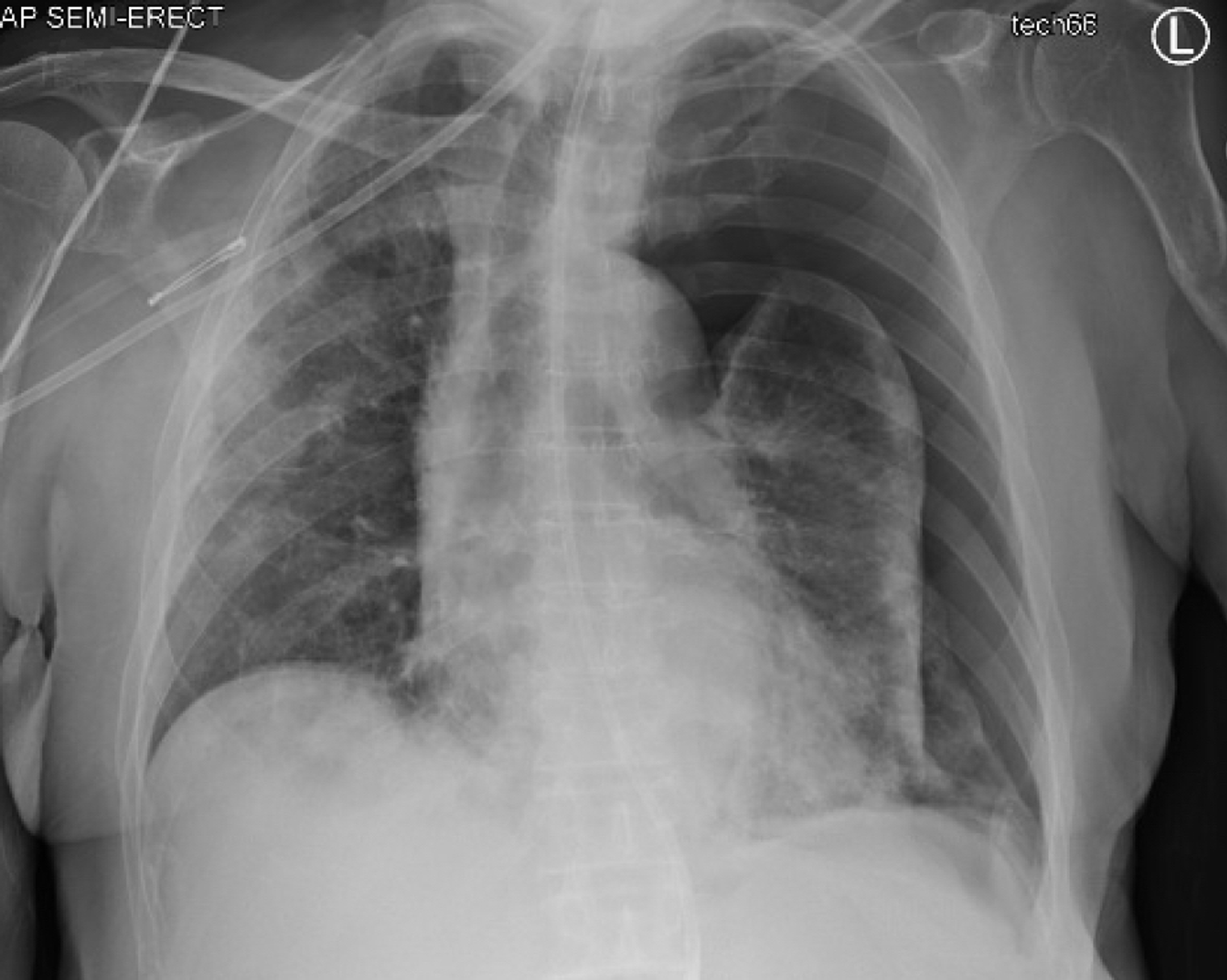 Cureus Secondary Spontaneous Pneumothorax in a COVID19 Recovered Patient