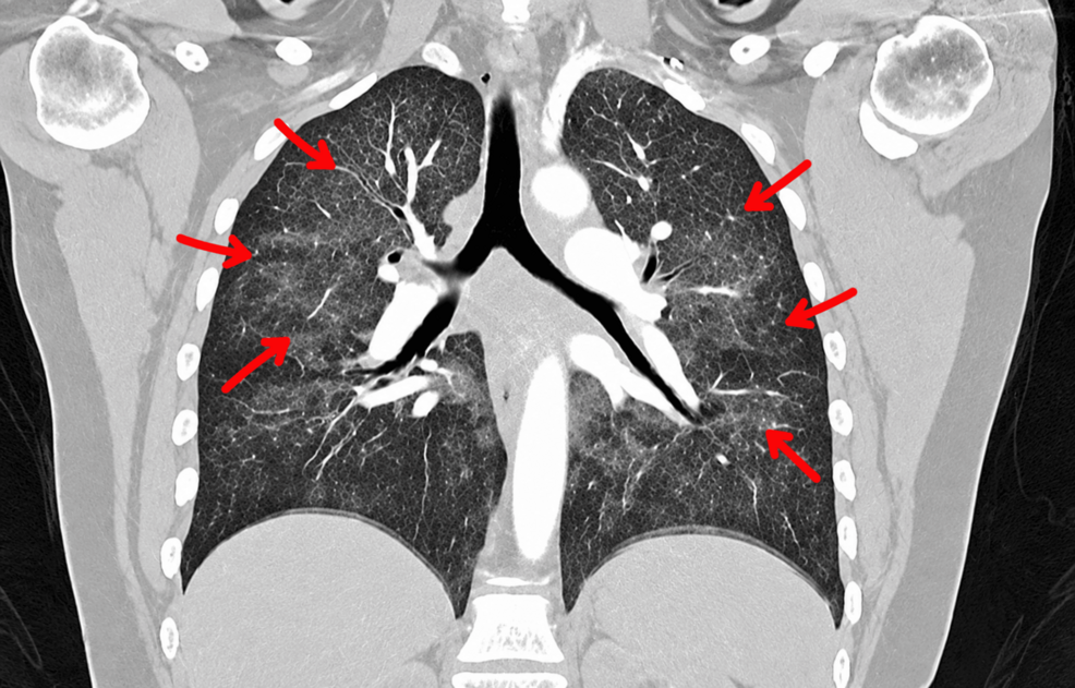 Pigeon Exposure Triggers Acute Hypersensitivity Pneumonitis and Respiratory Failure