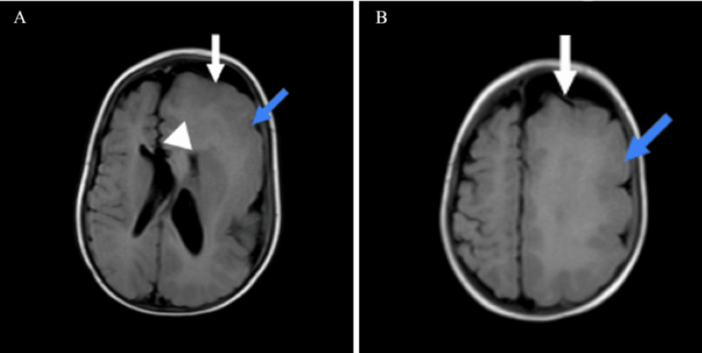 Hemimegalencephaly and Drug-Resistant Infantile Epileptic Spasms: Case Report