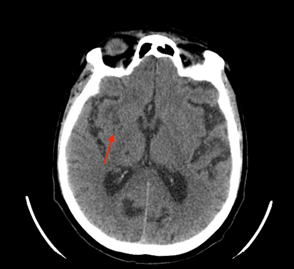 Atypical Lyme Neuroborreliosis Presenting With Ventriculitis and Cerebritis: A Case Report