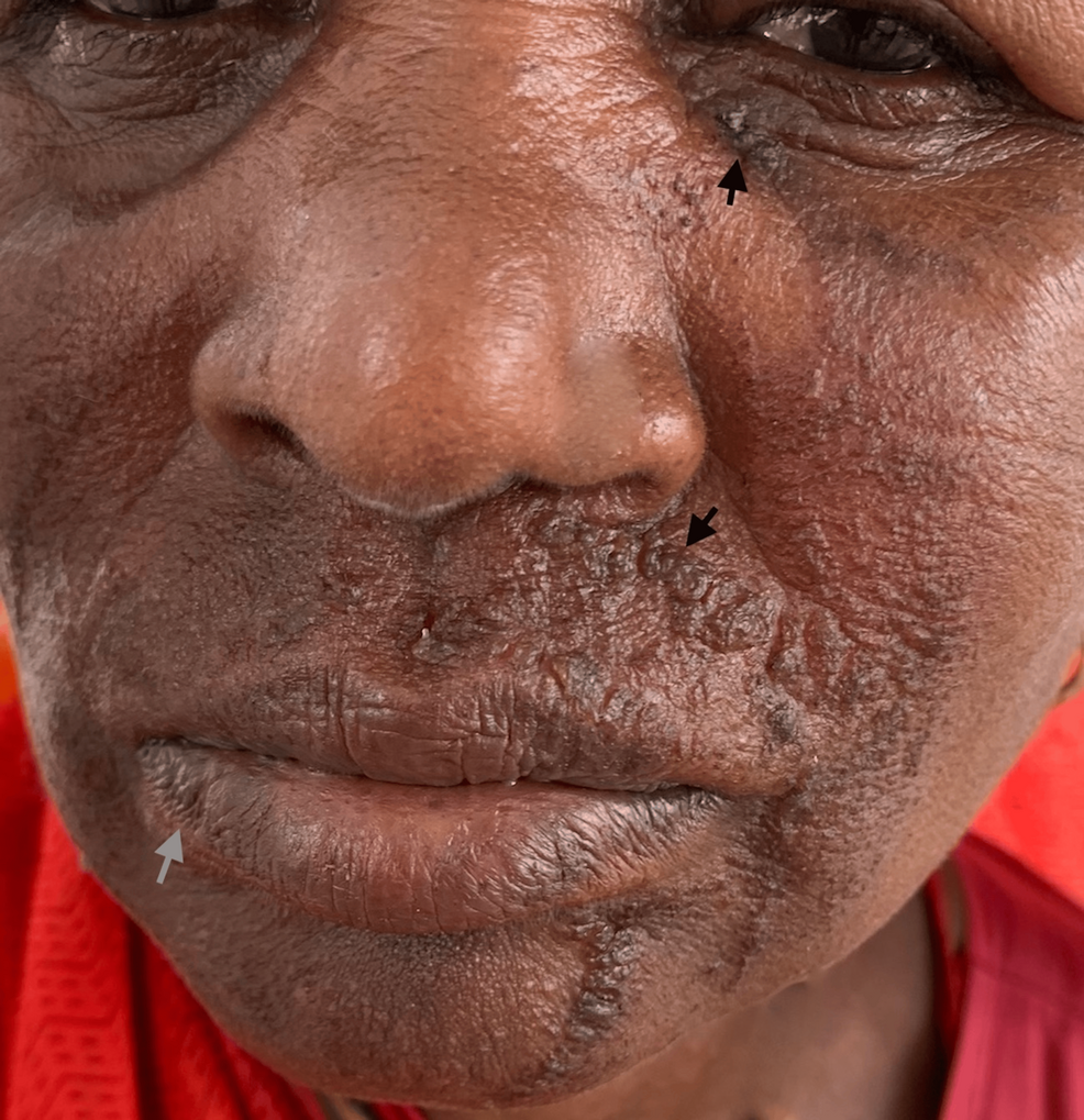 Atazanavir/Ritonavir-Associated Erythema Multiforme in an HIV-1-Positive Patient