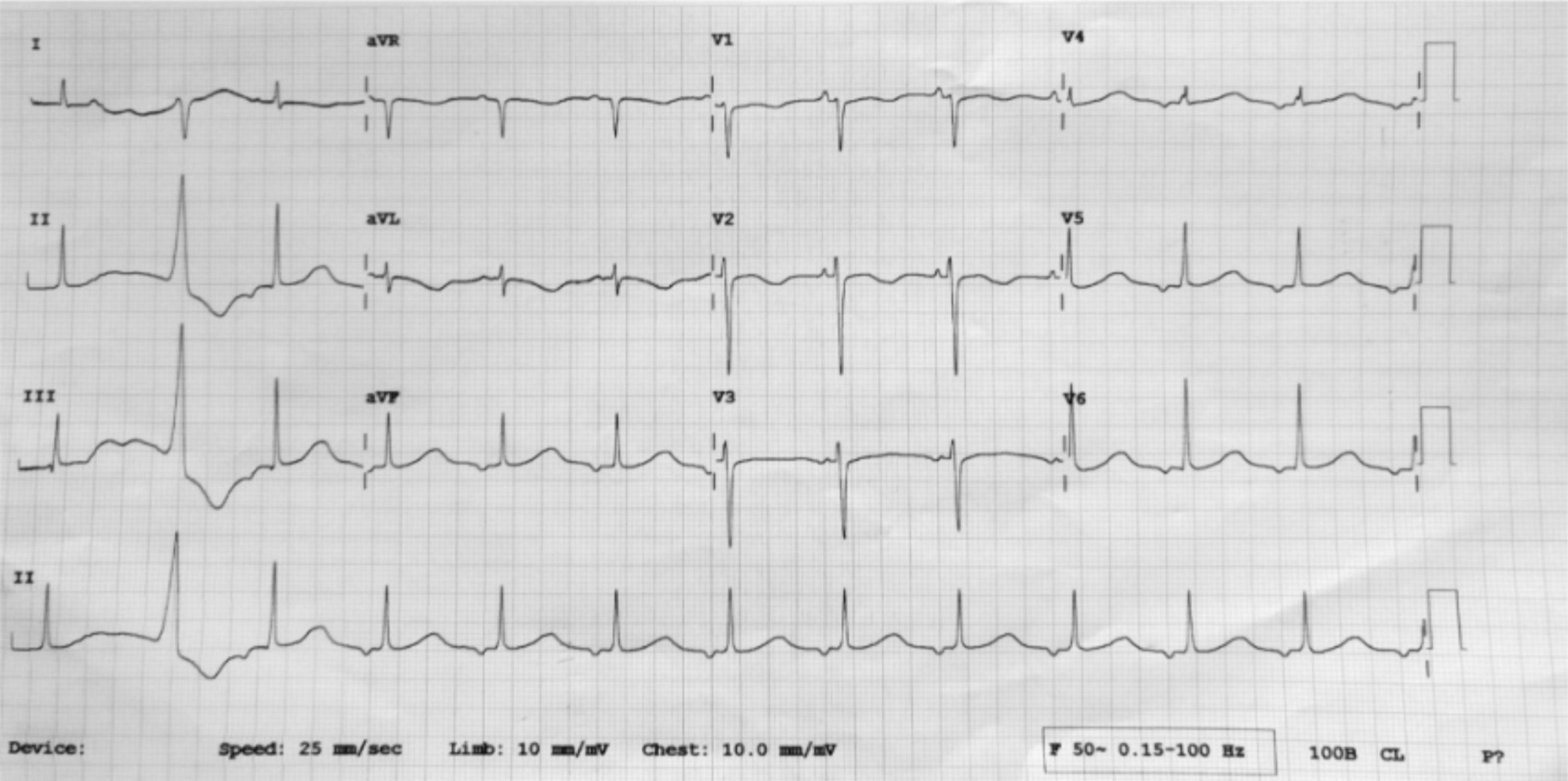 Cureus Long QTSyndrome With Torsades de Pointes Managed Considering