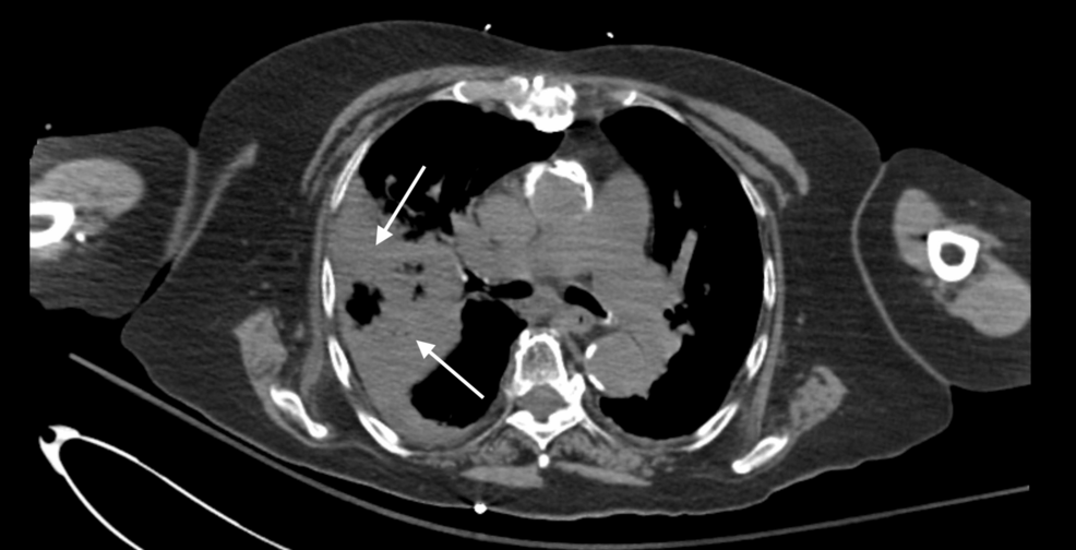 Progressive Pancytopenia in the Setting of Severe Pneumonia in a Patient With a History of Mantle Cell Lymphoma: A Case Report