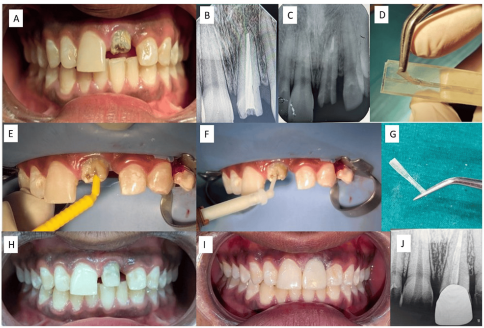 Reinforce, Don't Sacrifice: A Dentin-Preserving Alternative to Post-and-Core Restorations Using Ribbond, everStickPOST, and Interlig Fibers