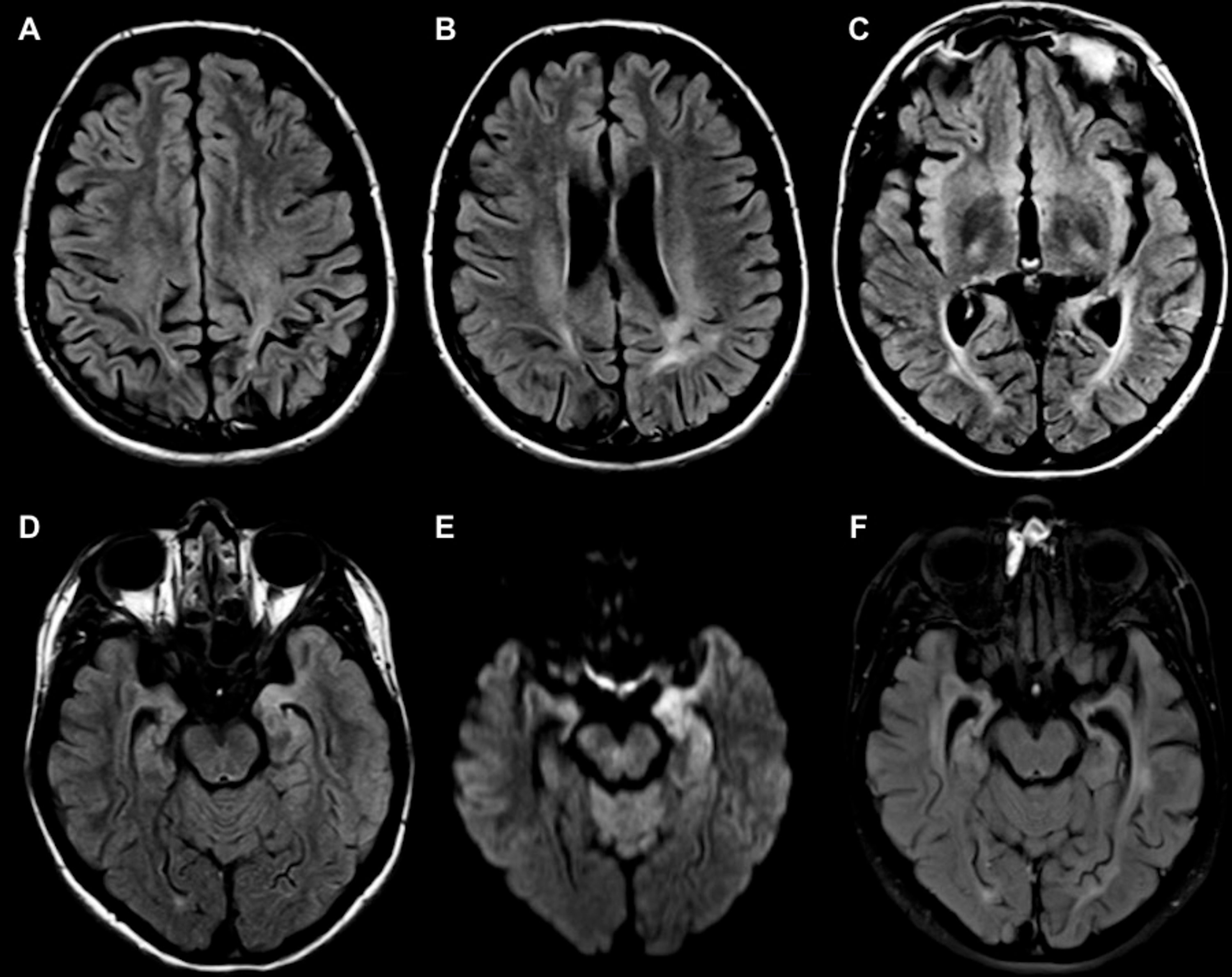 Cureus MRI Findings of Two Patients With Hashimoto Encephalopathy