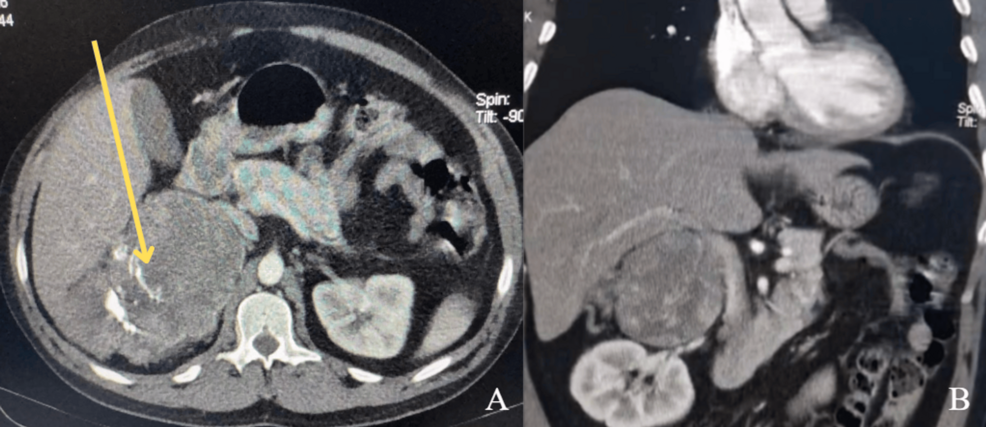 Acute Psychosis and Suicide Attempt as Initial Manifestations of Adrenocortical Carcinoma-Induced Cushing Syndrome: A Case Report