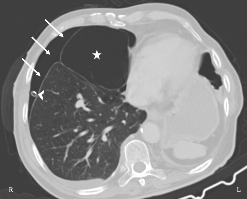 Preoperative-chest-computed-tomography
