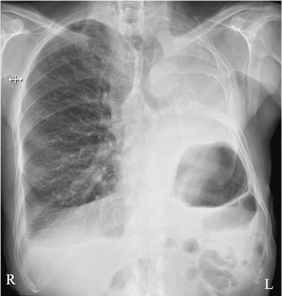 Postoperative-chest-radiograph-after-chest-drain-removal