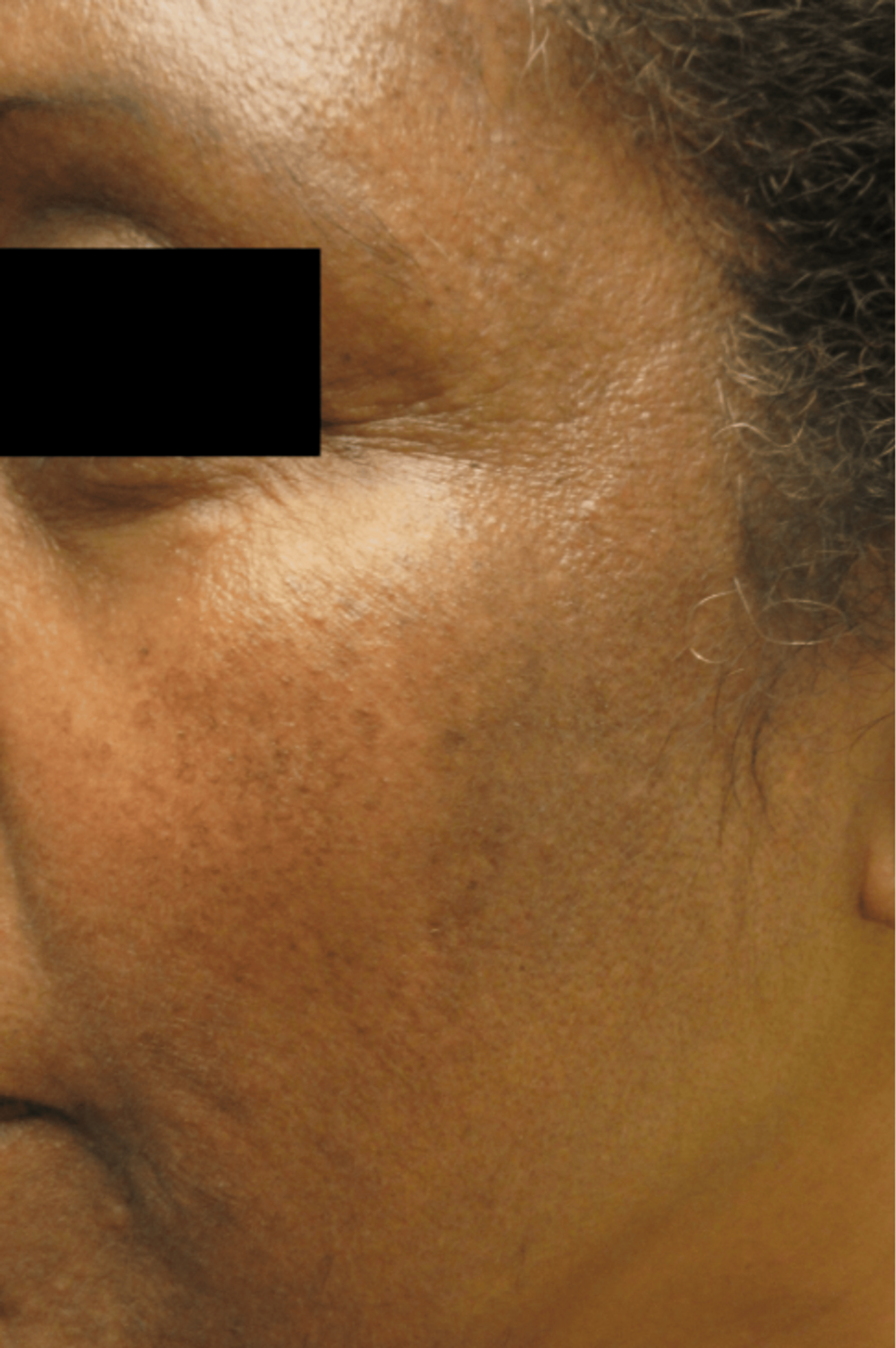 glutathione skin lightening supplement reviews Exogenous Ochronosis Masquerading As Melasma in of Color: Indications for Early Detection and Updated Clinical Review of Diagnosis, Pathomechanism, and Management Mitochondria at the crossroads EXCLUDE_Q&A Options:1 unit