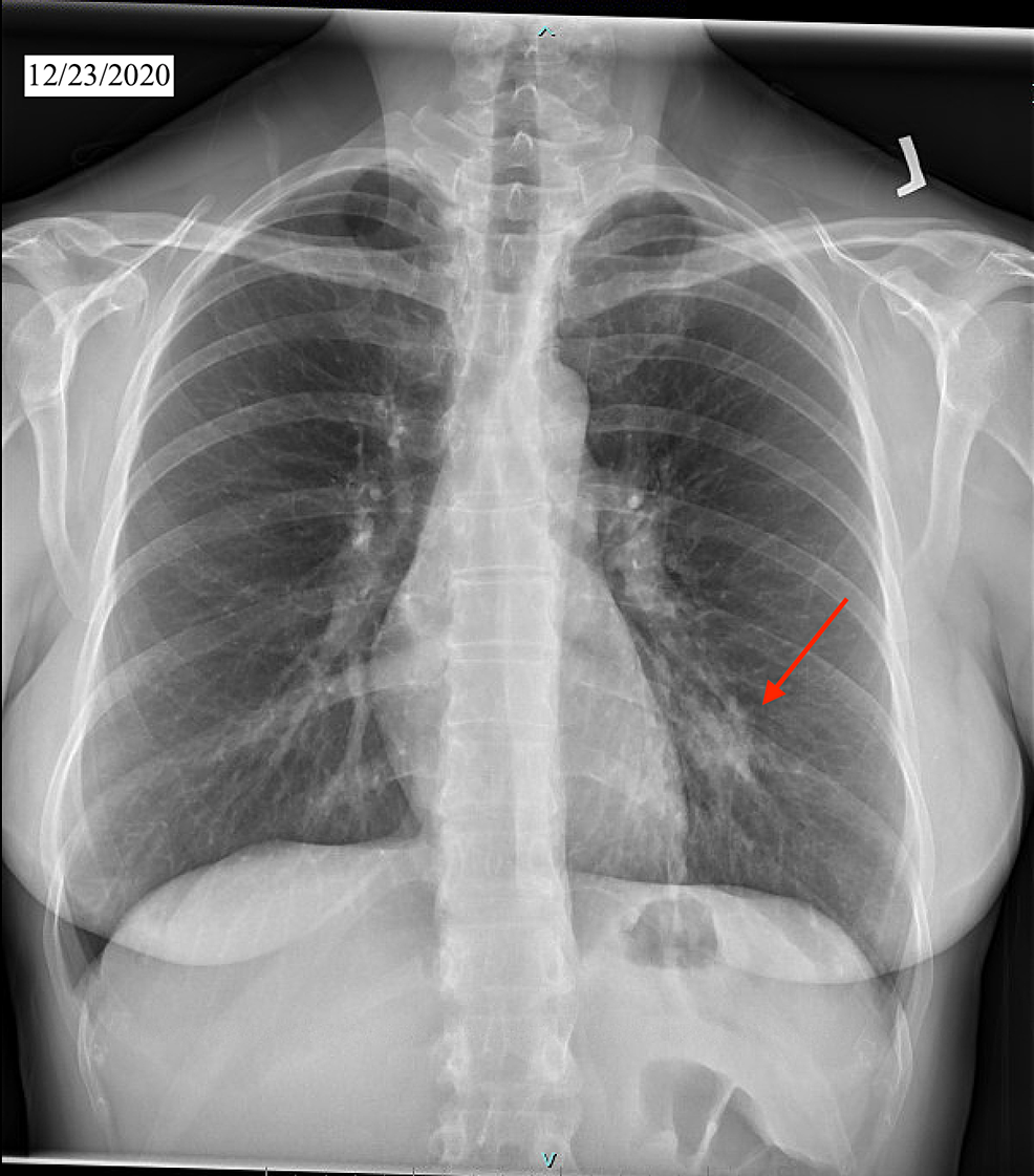 Cureus Cutaneous and Pulmonary Manifestations COVID19 Virus or