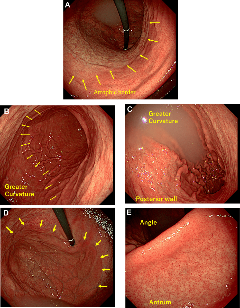 Photo: Cureus Suspected Autoimmune Gastritis Case Highlights Early Diagnosis in Young Adult Male