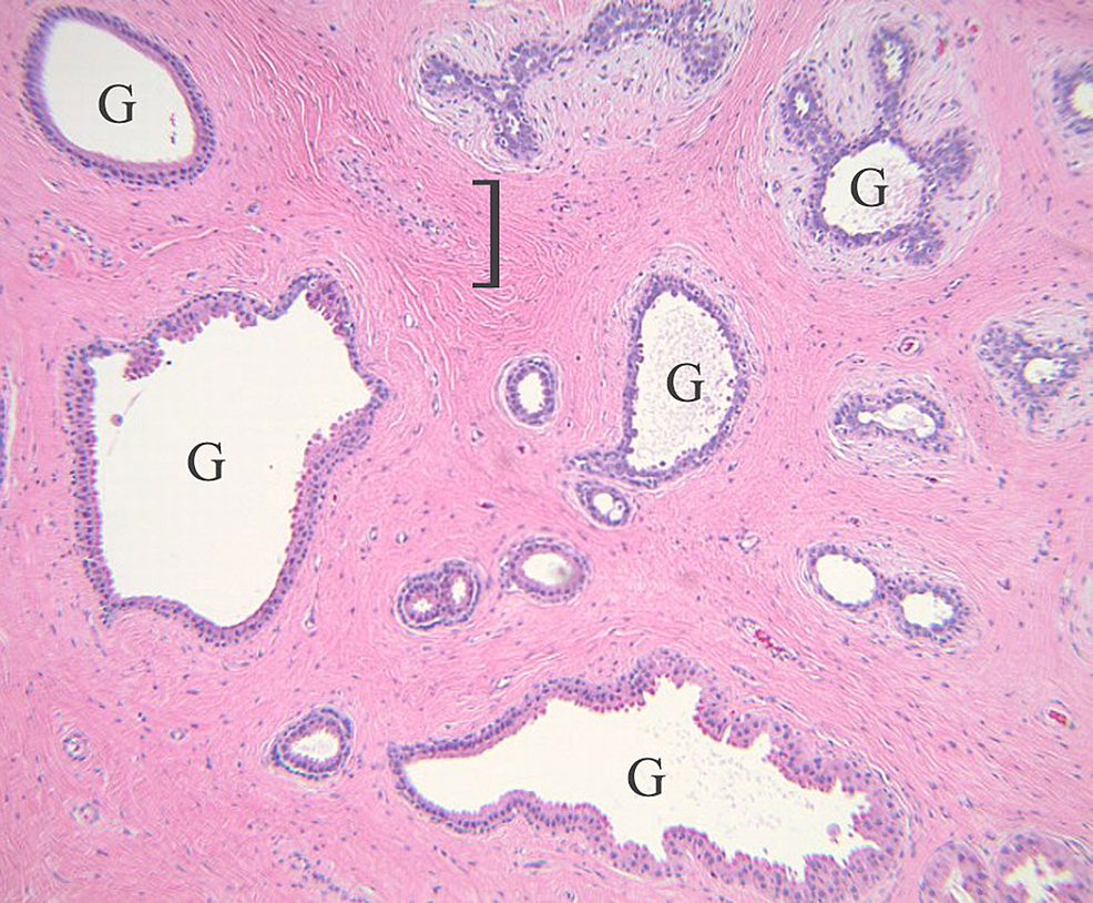 Cureus Cutaneous Periumbilical Fibroadenomas A Rare Case Of Ectopic Breast Tissue