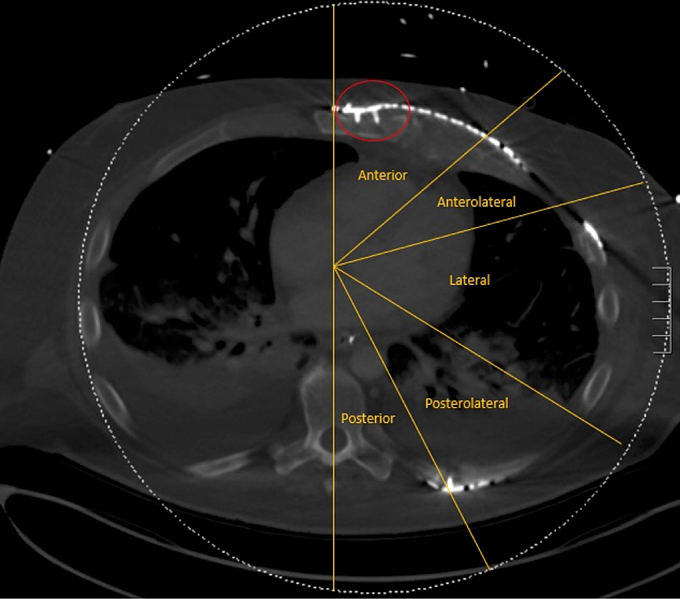 Cureus Cardiopulmonary ResuscitationInduced Hardware Failure After
