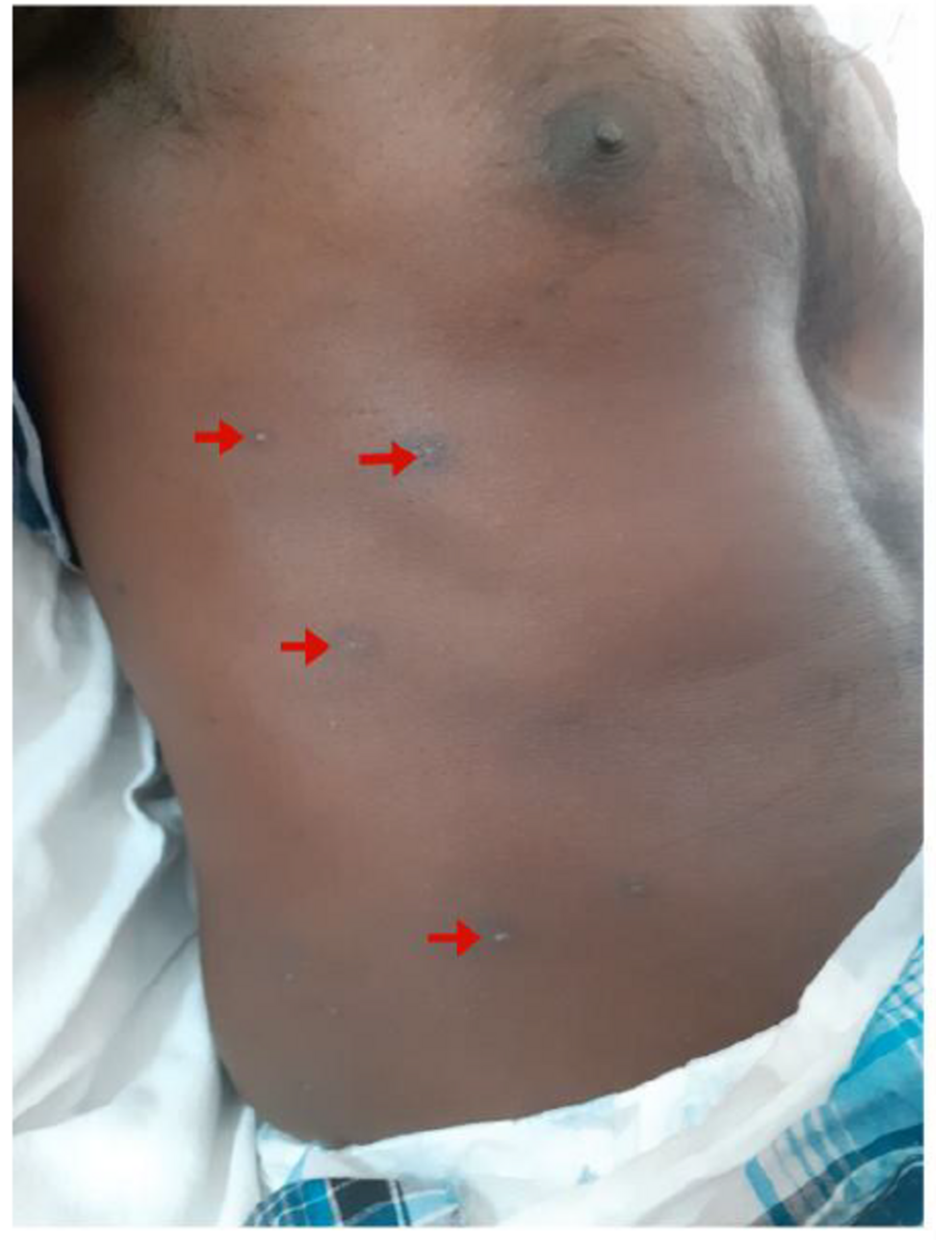 Cureus Guillain Barre Syndrome Following Chickenpox With Multiple Cranial Nerve Palsies And Cerebrospinal Fluid Pleocytosis