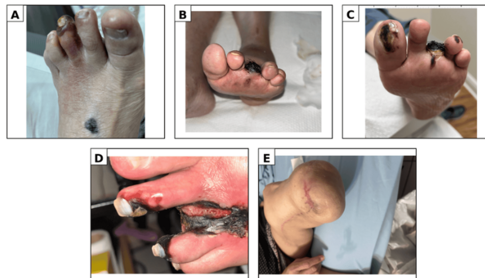 Blue Toe Syndrome Leads to Amputation Despite Source Control