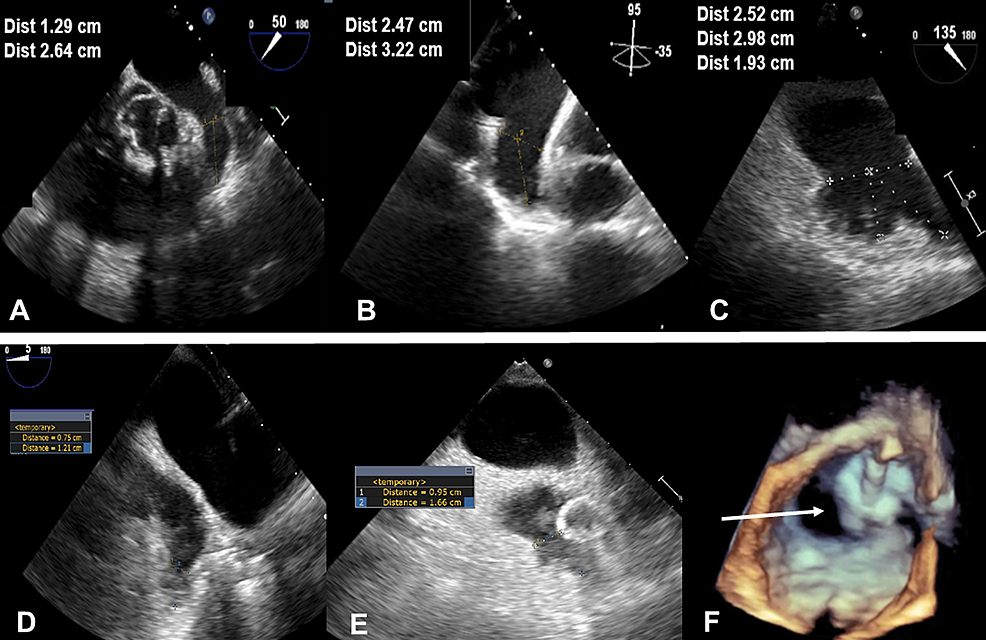 Cureus | Cardioform Septal Occluder For The Closure Of A Peri-Device ...