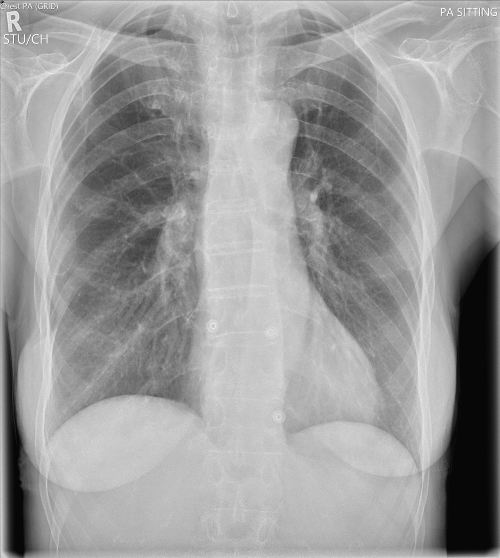 Posterior-anterior-chest-radiograph-on-admission-demonstrating-hyperinflated-lung-fields-with-coarse-bronchovascular-markings
