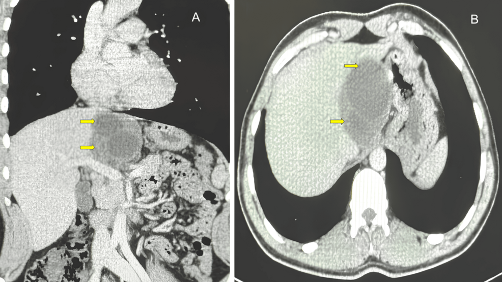 CT scans in two planes show a large, darker area in the liver, marked by arrows