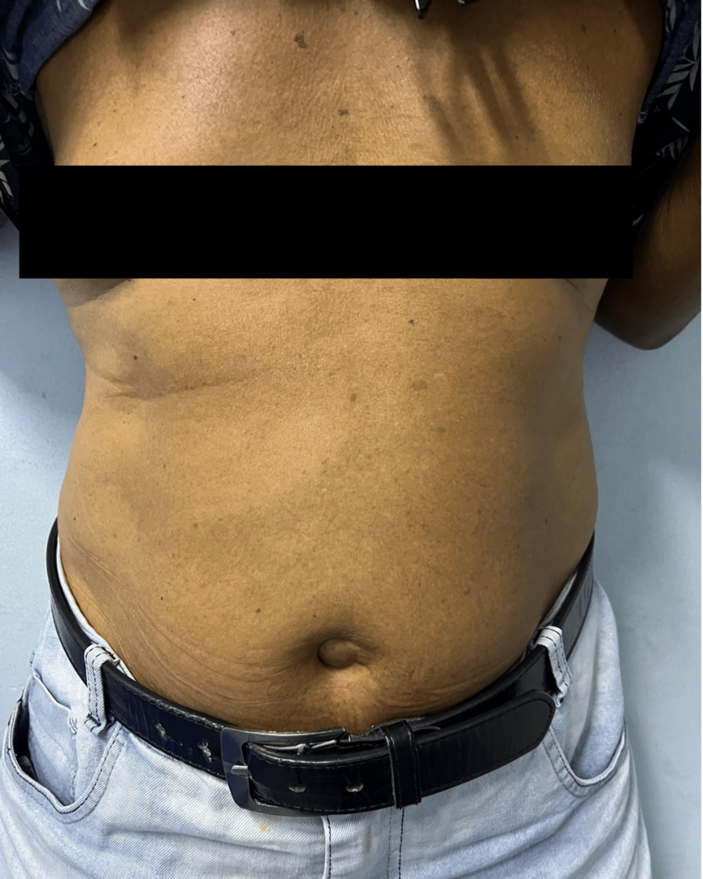 Anterior-abdominal-wall-showing-umbilical-prominence