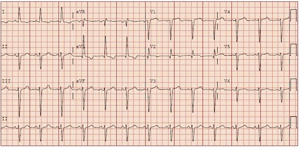 Cureus | A Rare Presentation of Cardiac Lipoma as an Acute Coronary ...