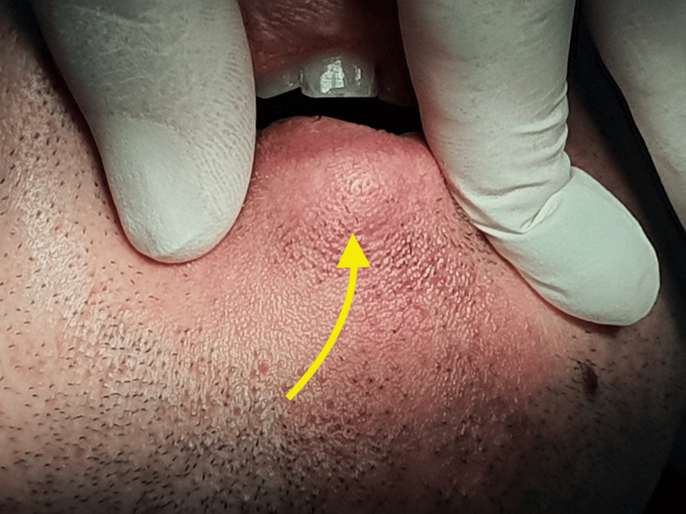 A Case Report of Pleomorphic Adenoma of the Lower Lip: An Uncommon Location and a Diagnostic Pitfall - Cureus