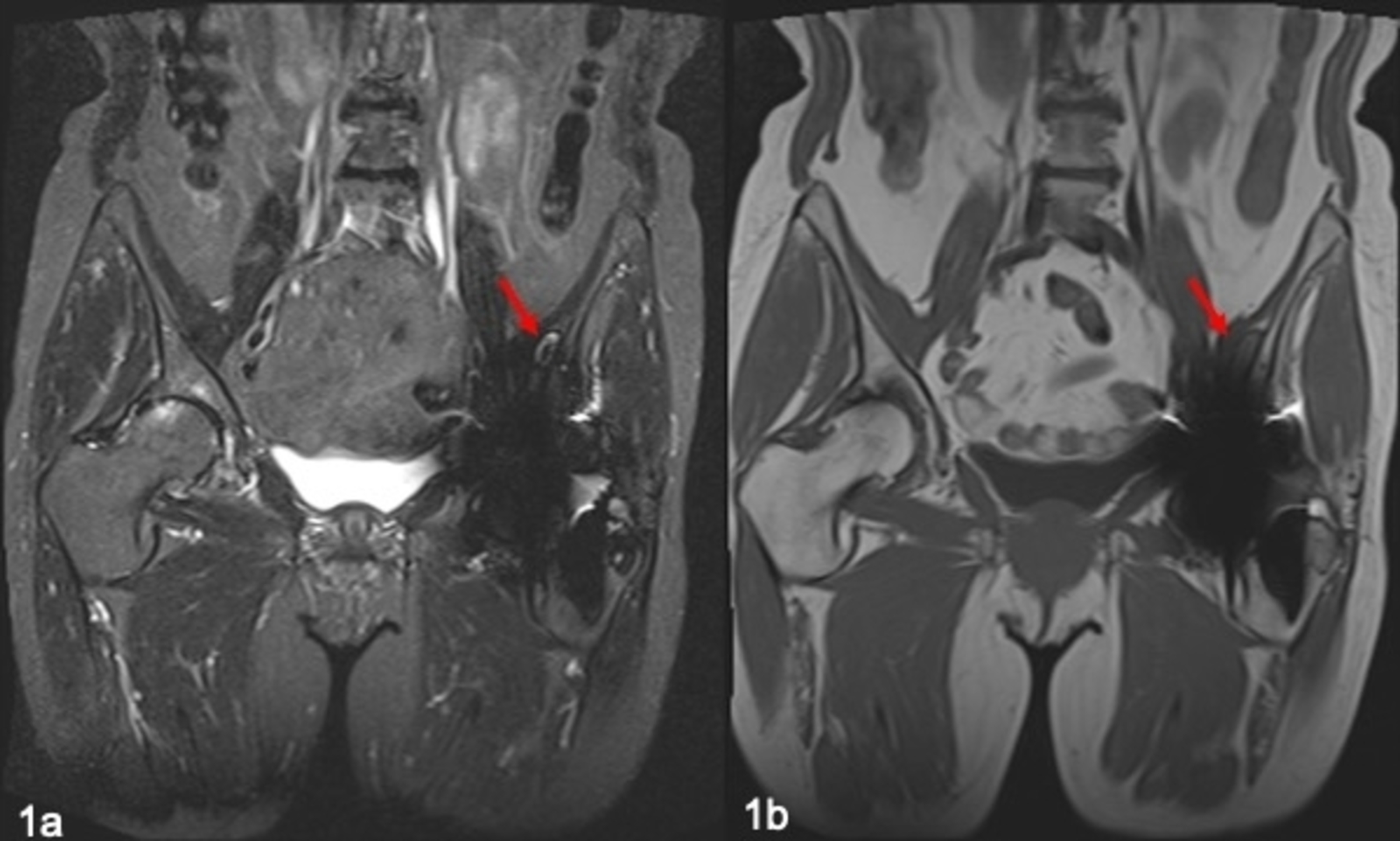 hip replacement metallosis hip replacement metallosis