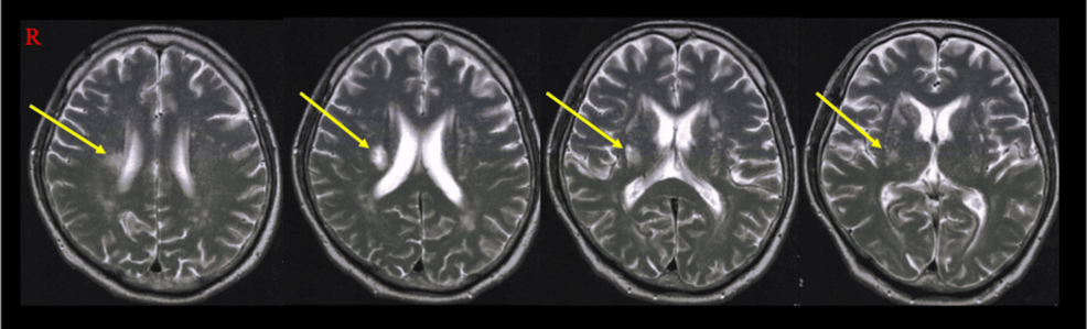 Case report: Phased robotic gait training for post-stroke hemiplegia