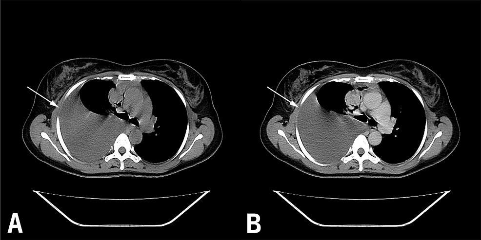 A.-Plain-CT-(axial-view)-showing-the-pleural-effusion-on-the-right-side;-B.-CT-with-contrast-(axial-view)-showing-the-pleural-effusion-on-the-right-side