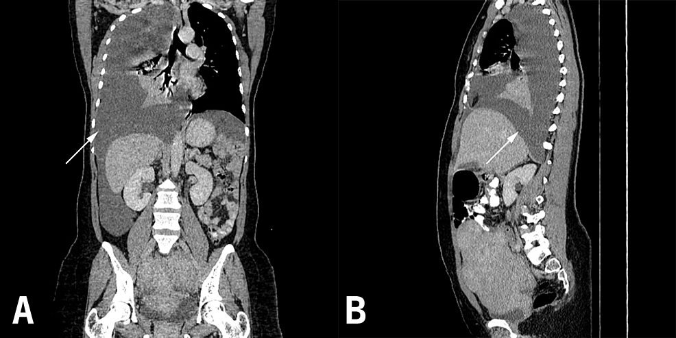 A:-CT-with-contrast-(coronal-view)-showing-the-pleural-Effusion-and-consolidation-in-the-adjacent-lung-parenchyma.--Fig-5.B.--CT-with-contrast-(sagittal-view)-showing-the-pleural-effusion.