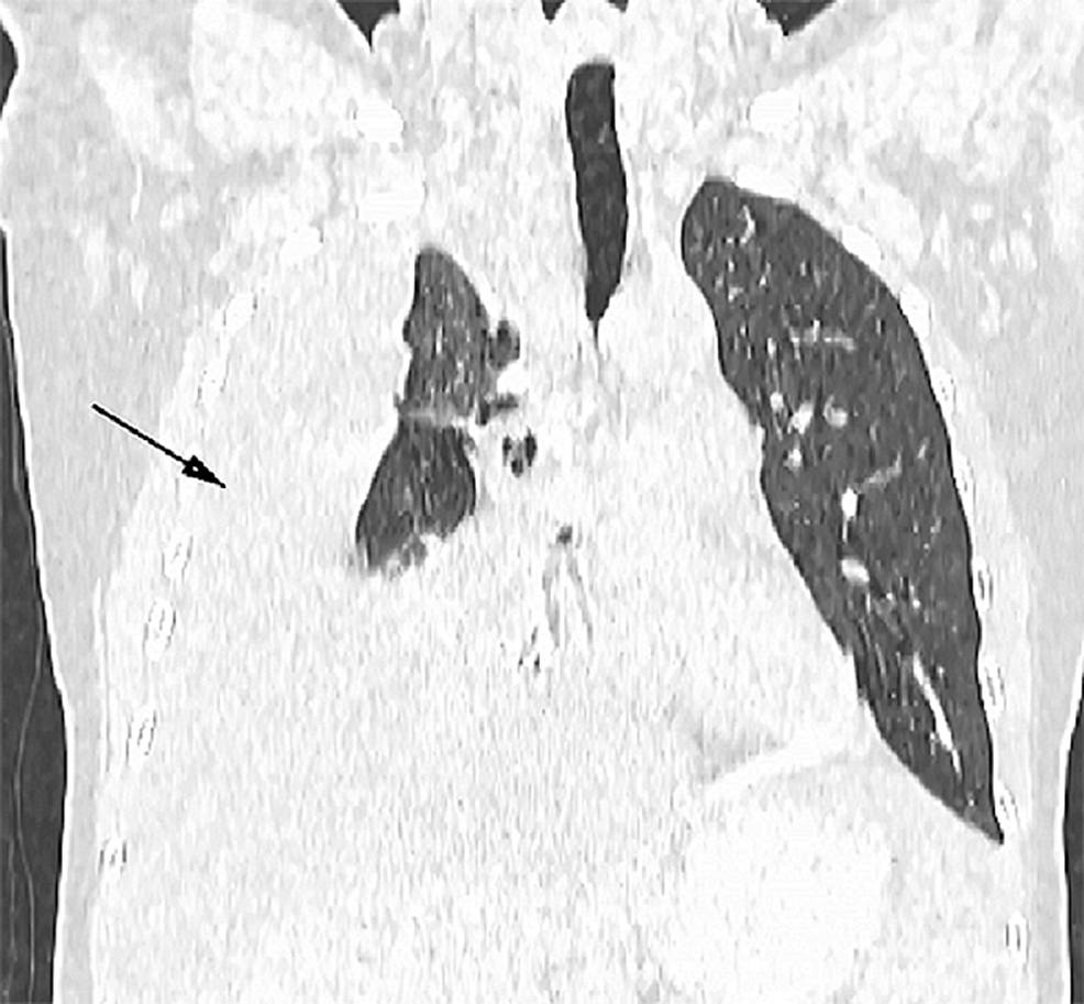 Coronal-plain-lung-window-showing-the-pleural-effusion-with-atelectasis-in-the-adjacent-lung-parenchyma