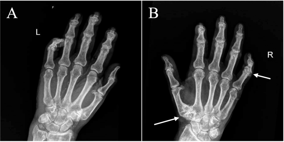 When Diabetes Mimics Scleroderma: Cheiroarthropathy and Neuropathic Digital Erosions in Type 2 Diabetes