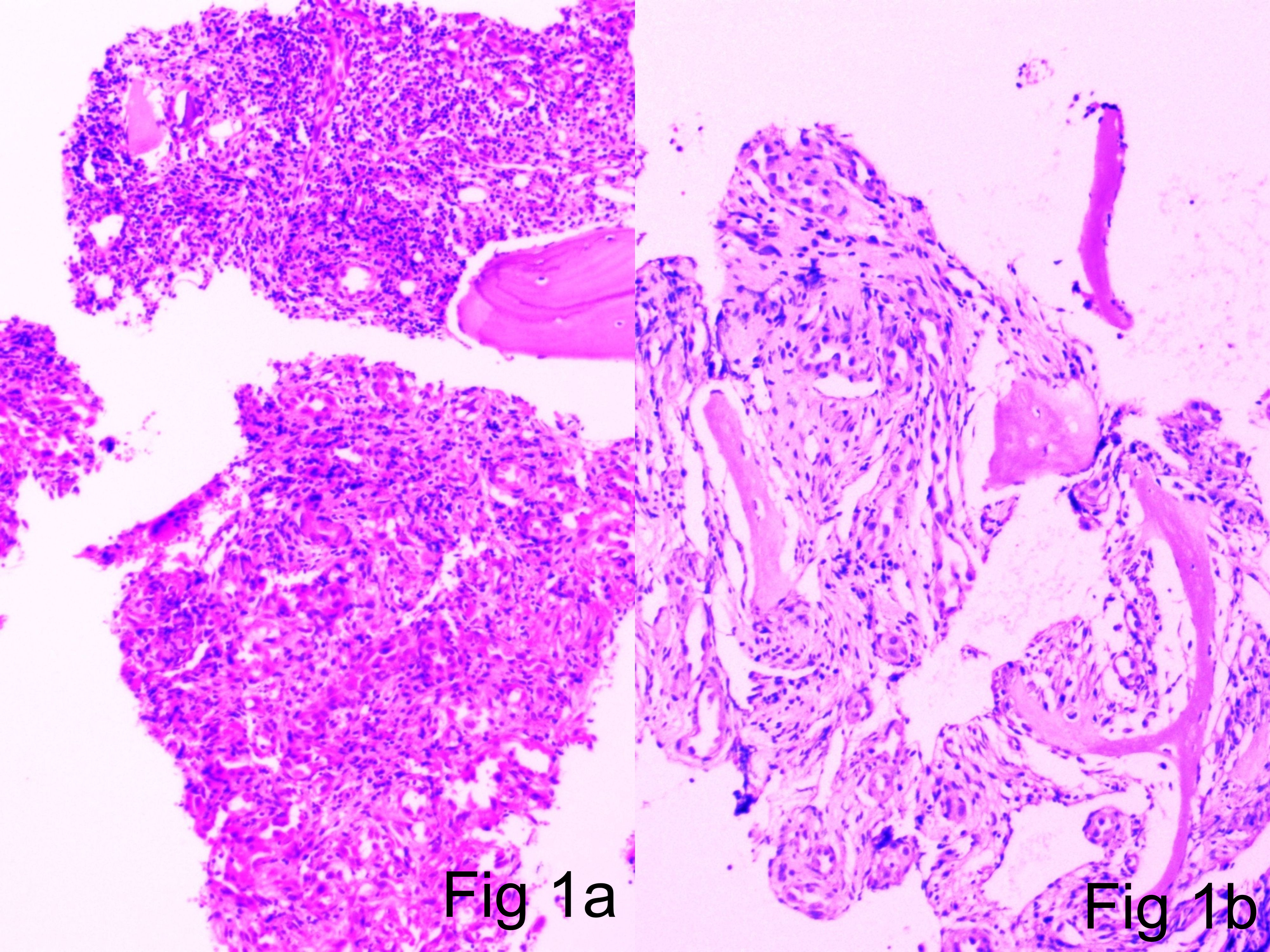 Cureus | Epithelioid Haemangioma of Bone: A Case Series and Comprehensive  Literature Review Reappraising the Diagnostic Classification of All  Epithelioid Vascular Neoplasms of Bone